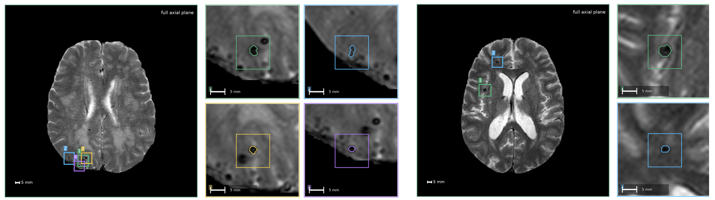 Figure 1: Representative appearance of cerebral microbleeds (CMBs) on T2*-weighted gradient-echo MRI (T2*-GRE, VALDO), shown for two subjects. Coloured boxes and enlarged crops show individual CMBs as small rounded hypointense foci with reference contours. Scale bars: 5 mm.