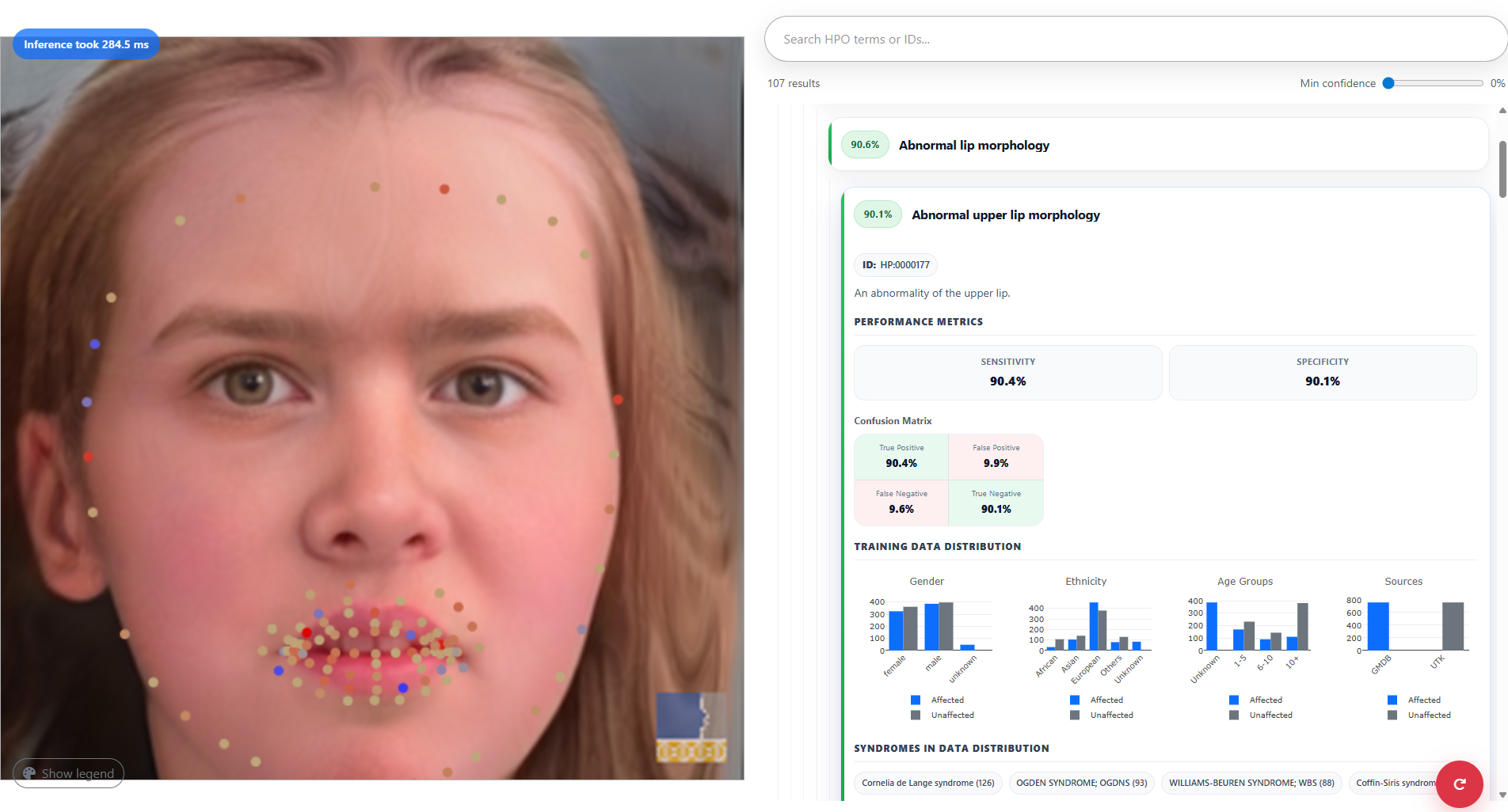 Figure 7: The detailed view of a model’s summary in performance, training data, and feature importance in the FaceMesh2HPO web application. GestaltGAN [23] was used to synthesize the exemplary patient photograph.