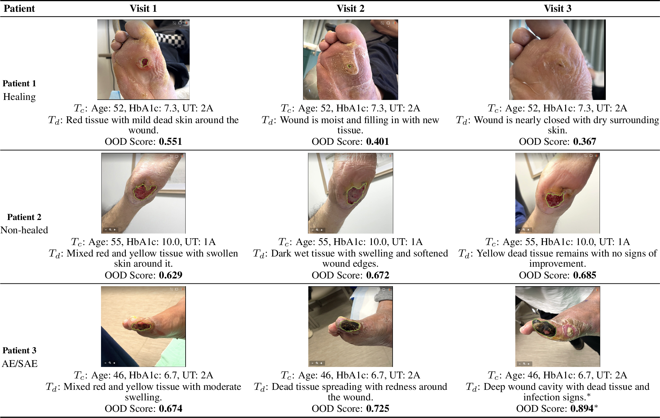 Figure 5: Representative wound trajectories for three patients across longitudinal visits. For each visit, we show the structured clinical context (T_c: age, HbA1c, UT grade), a plain-language wound description (T_d), and an OOD score measuring how much the sample deviates from the training distribution. Higher OOD scores indicate greater anomaly.