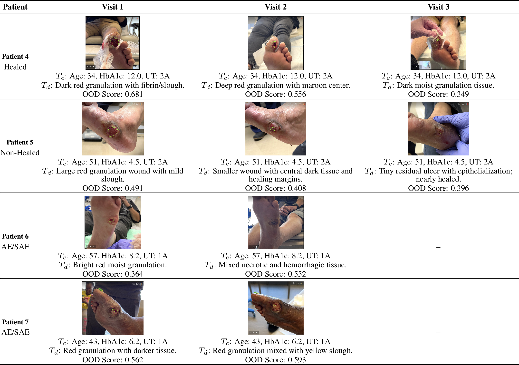 Figure 6: Representative wound trajectories for five patients across longitudinal visits. For each visit, we show the structured clinical context (T_c: age, HbA1c, UT grade), a brief wound description (T_d), and the corresponding OOD score produced by our model. Higher OOD scores indicate greater deviation from the training distribution and potentially increased risk of adverse outcomes.