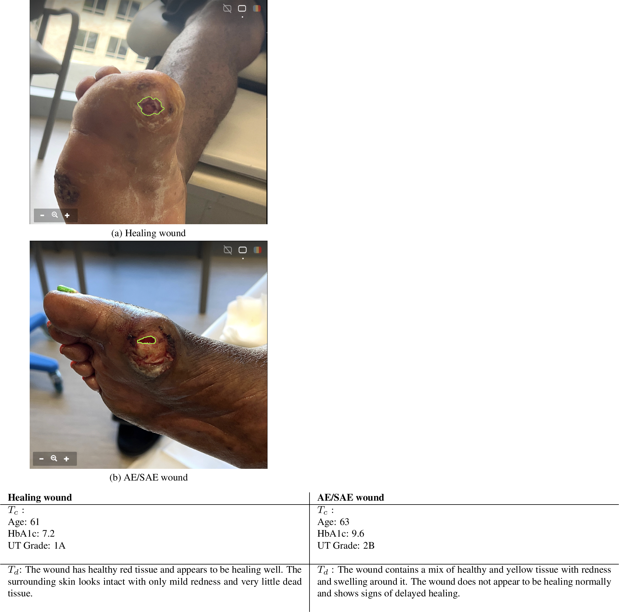 Figure 1: Illustrating the need for multimodal reasoning. Although both wounds exhibit similar visual appearance and comparable wound size, their associated structured clinical information (T_c) and descriptive wound characteristics (T_d) indicate markedly different clinical trajectories. This ambiguity motivates integrating cross-contextual information beyond visual appearance alone.