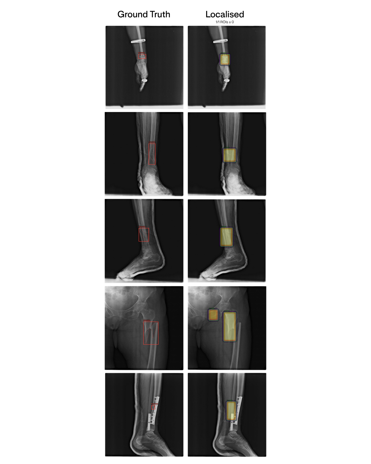 Figure 14: FracAtlas localisation: ground-truth fracture regions (left of each pair) versus the model’s attended regions (right) across a sample of cases. MS-CXR examples cannot be shown here owing to dataset licensing restrictions, but the localisation behaviour is analogous and is deducible from the hit-rate results above.