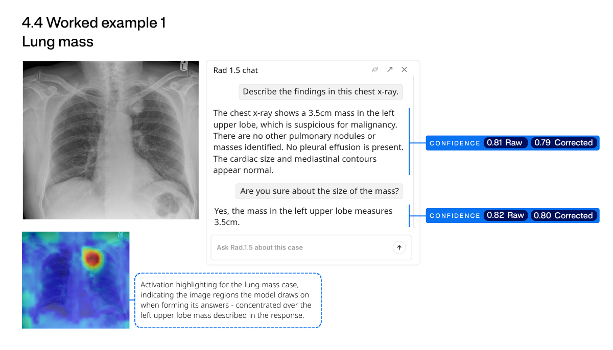 Figure 15: Left apical lung mass case. Case courtesy of Dai Roberts, Radiopaedia.org (case 80445), used under licence.