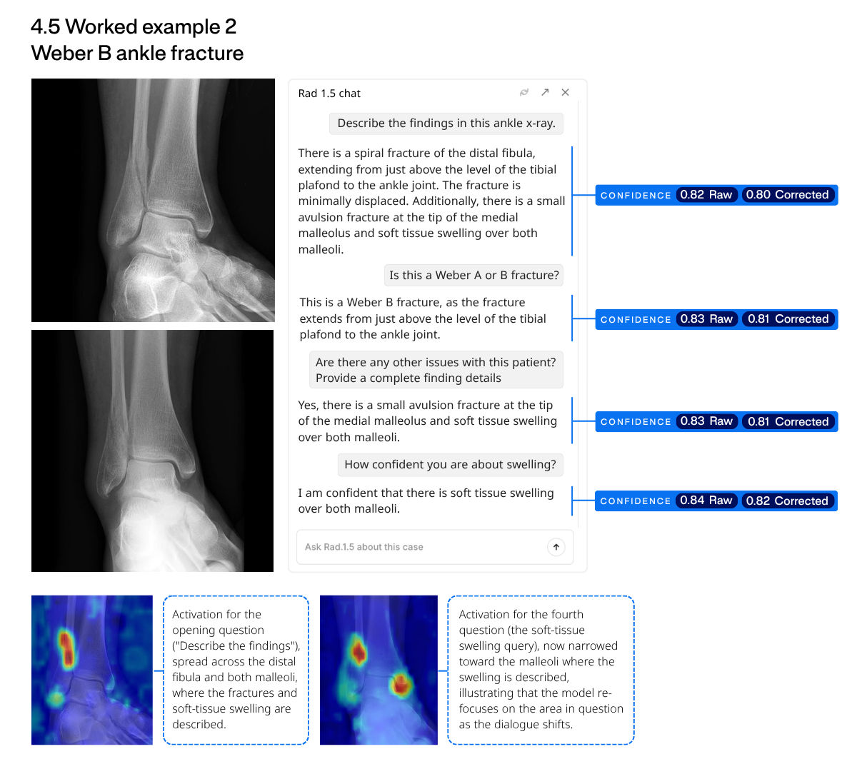 Figure 16: Ankle Weber B fracture. Case courtesy of Frank Gaillard, Radiopaedia.org (case 7480), used under licence.