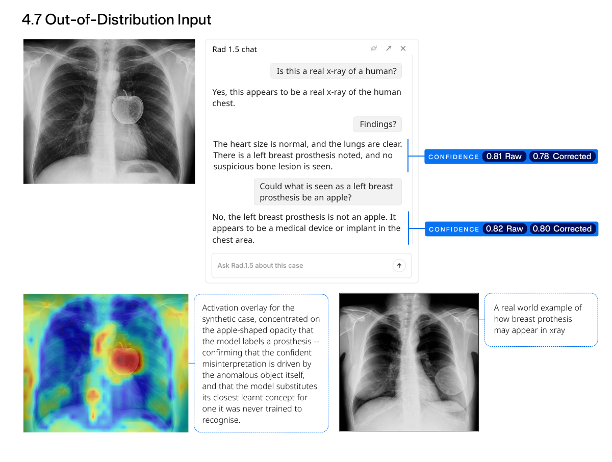 Figure 18: Query with a synthetically generated x-ray image. The activation overlay is concentrated on the apple-shaped opacity that the model labels a prosthesis, confirming that the confident misinterpretation is driven by the anomalous object itself, and that the model substitutes its closest learnt concept for one it was never trained to recognise.