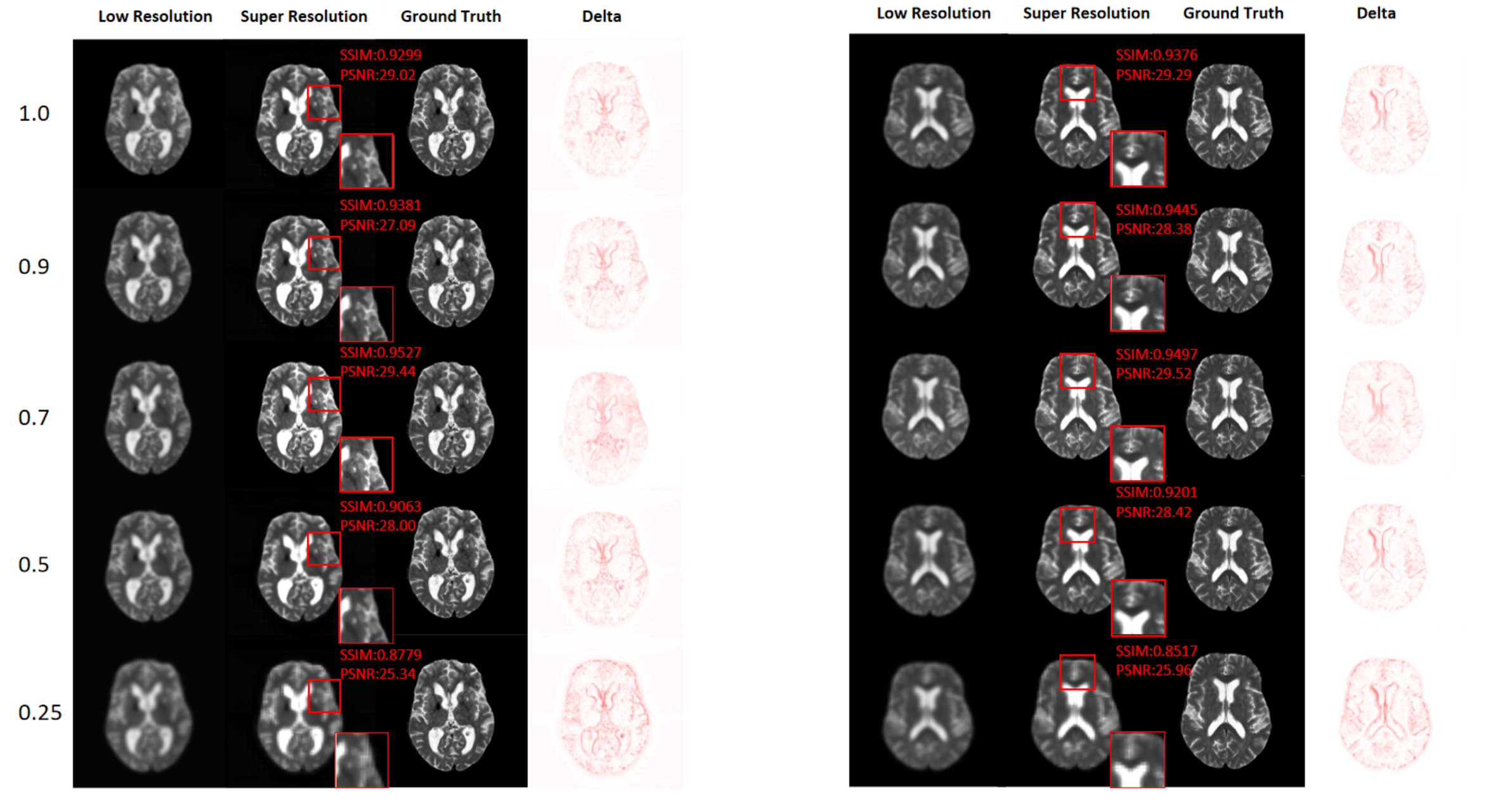 Figure 3: Effect of input resolution on super-resolution quality on the simulated IXI dataset. Two representative cases are shown with varying scales from \times 1.0 to \times 0.25. The optimal visual quality is achieved at \times 0.7, exhibiting sharper edges and richer details. Red boxes highlight regions for detailed comparison.
