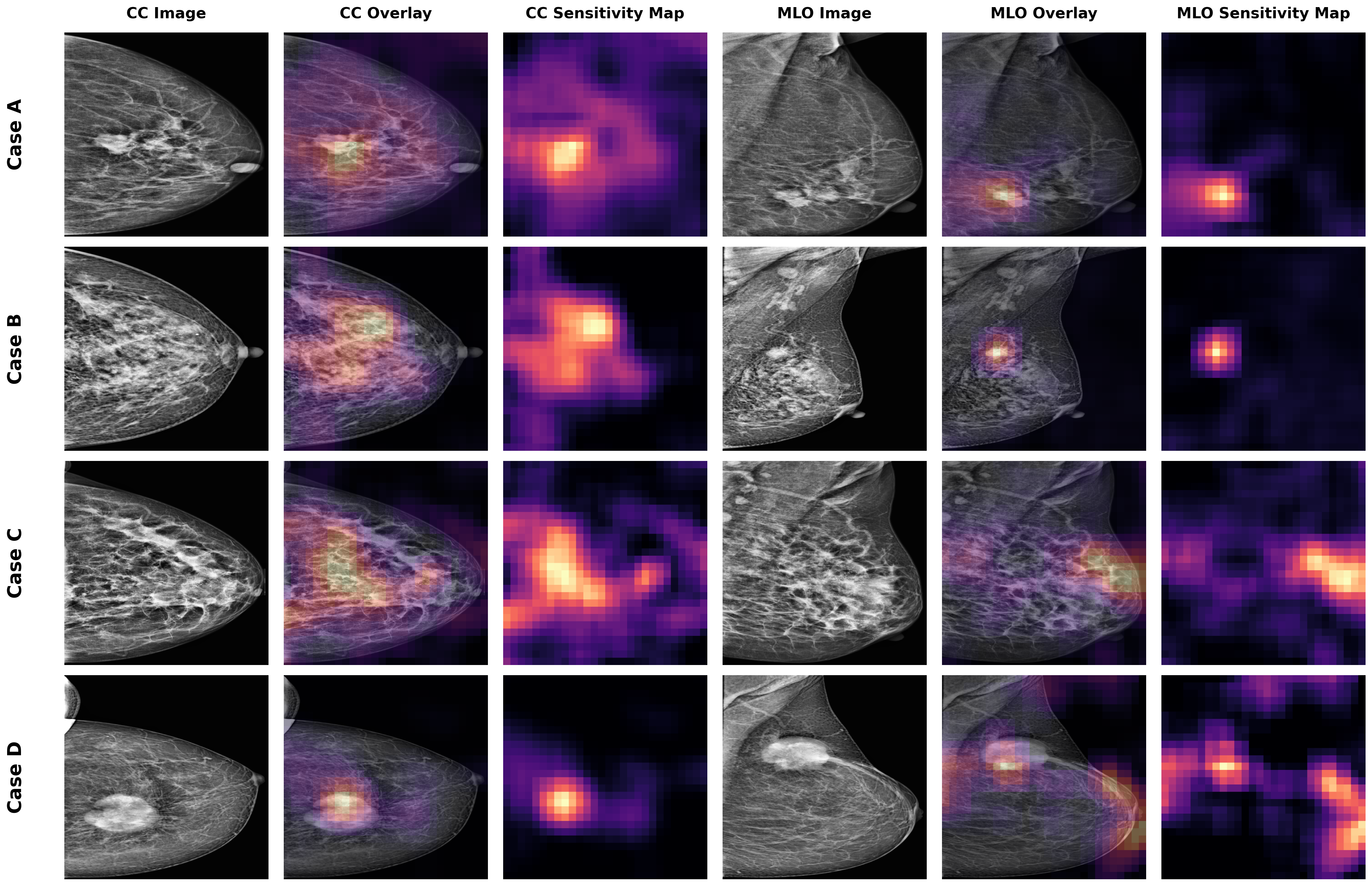 Figure 4: Qualitative interpretability results obtained using occlusion-based sensitivity analysis [32]. From left to right, the columns present the original craniocaudal (CC) image, the CC overlay, the CC sensitivity map, the original mediolateral oblique (MLO) image, the MLO overlay, and the MLO sensitivity map. Regions with warmer colors correspond to image areas whose occlusion leads to a larger reduction in the predicted class score, indicating stronger influence on the model’s decision.