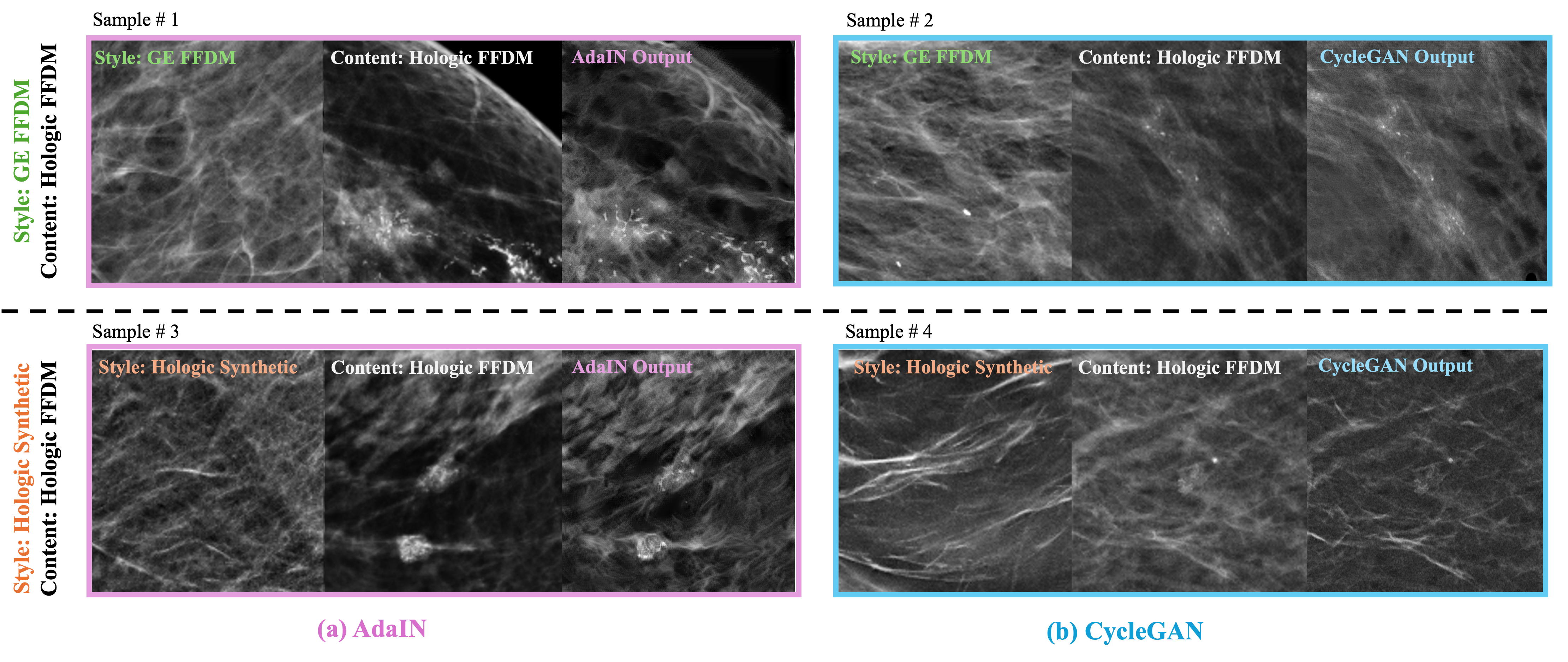 Figure 7: Visual comparison of style transfer results. GE FFDM and Hologic synthetic patches were used as style patches in the first and second rows, respectively, while Hologic FFDM patches are used as content patches in both rows. The first and second columns show results from AdaIN and CycleGAN, respectively.