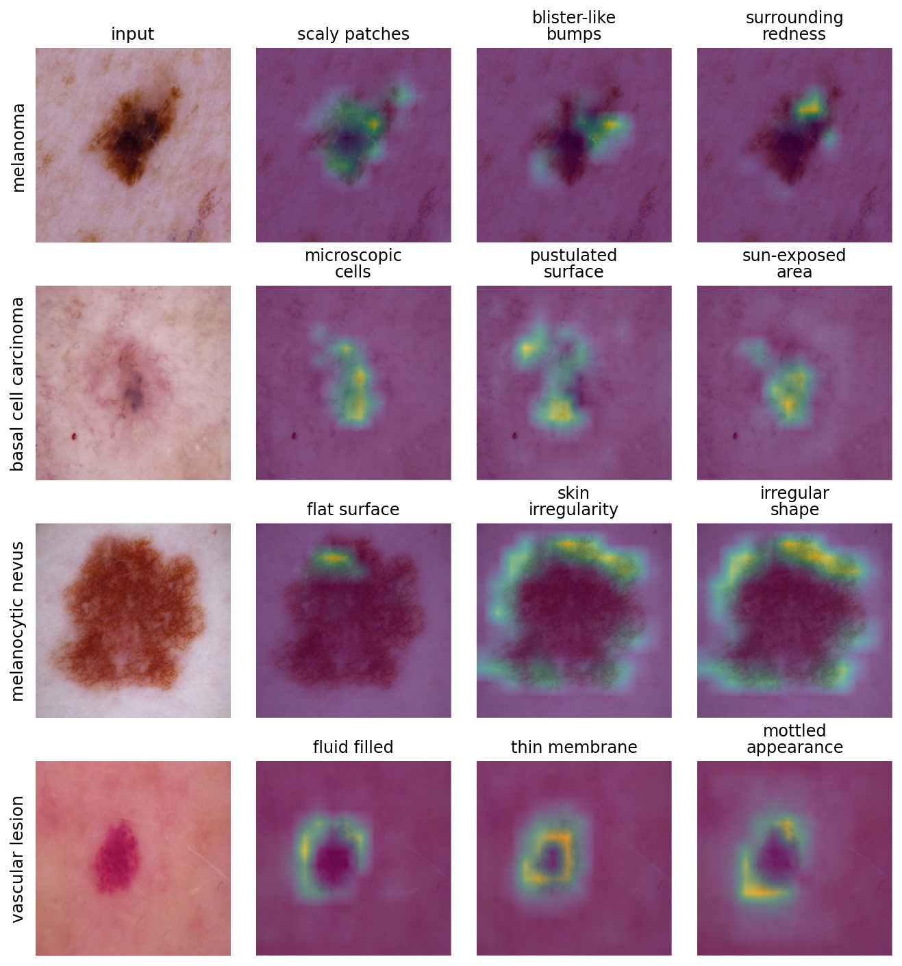 Figure 8: LAD concepts on dermoscopy (HAM10000, BiomedCLIP). Top concepts for four lesion classes. The maps are spatially coherent and consistent but localize mainly to the lesion boundary and surrounding skin (e.g., “irregular shape” and “skin irregularity” ringing the nevus; “fluid filled”/“thin membrane” encircling the vascular lesion) rather than the diagnostic interior, with basal cell carcinoma a partial exception. This boundary bias is consistent with the lower concept-deletion score in this domain (¿tbl:tab:dermoscopy?).