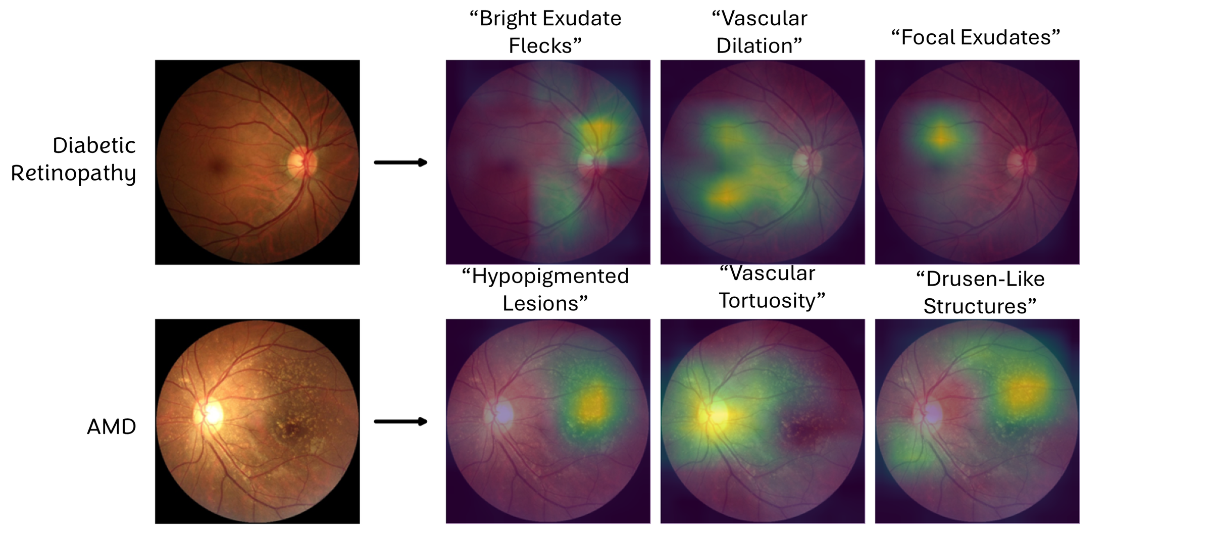 Figure 5: Named-concept rollouts on retinal fundus images. For a diabetic retinopathy case (top) and an age-related macular degeneration case (bottom), LAD decomposes the prediction into separately named, localized concepts. Each map is anchored to a clinical term, so the explanation reports both where the model looks and what it attributes to that region. Two representative classes are shown; per-disease results are in the supplement.