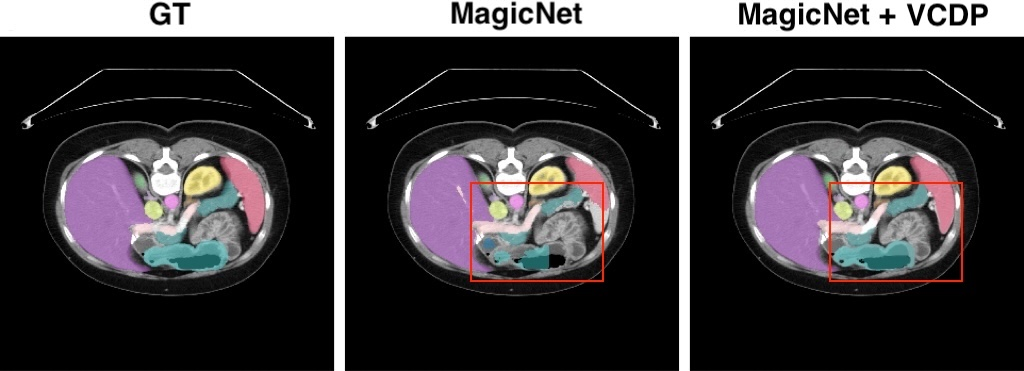 Figure 3: Qualitative comparison on the 20% labeled Synapse dataset, with a focus on the pancreas. Red boxes highlight the pancreas region. Compared with MagicNet, VCDP produces a more complete pancreas mask that is closer to the ground truth. Organ legend: spleen, right kidney, left kidney, gallbladder, esophagus, liver, stomach, aorta, inferior vena cava, portal/splenic vein, pancreas, right adrenal gland, and left adrenal gland.