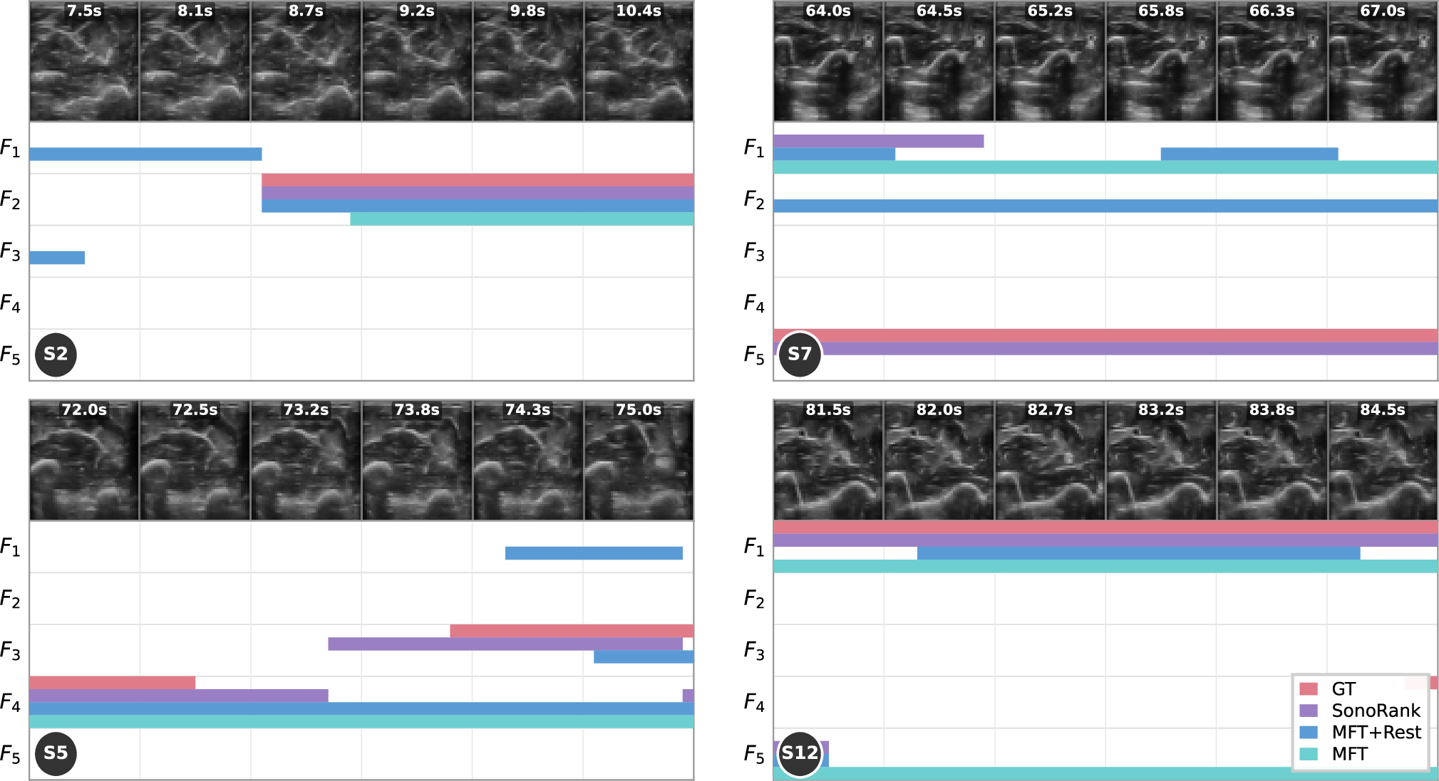 Figure 4: Representative examples of finger flexion predictions on four test subjects. Each panel shows six ultrasound frames spanning a 3 s flexion interval (top) and the corresponding ground-truth and predicted flex labels for all five fingers (bottom). (Top-left) S2: clean F_2 (index) detection. SonoRank matches the ground truth perfectly while baselines produce shorter or misaligned events. (Top-right) S7: F_5 (pinky) flexion that SonoRank detects but both MFT+Rest and MFT miss entirely. (Bottom-left) S5: coupled F_3/F_4 (middle/ring) flexion. SonoRank captures the dominant fingers but adds a spurious F_4 event. (Bottom-right) S12: F_1 (thumb) flexion, the hardest finger. All methods detect the event, yet SonoRank aligns most closely with the ground truth.