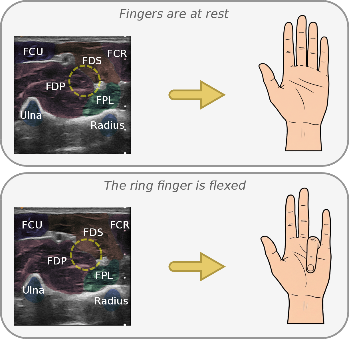 Figure 1: Ultrasound can see what EMG cannot: B-mode cross-sections of the forearm (top of each image is the skin surface) at rest (top) and during ring-finger flexion (bottom), with the corresponding hand pose on the right. Muscle regions and bones were manually annotated for illustration purposes: the flexor digitorum superficialis (FDS) and profundus (FDP), the two extrinsic muscles that actuate the four fingers, are highlighted alongside the Ulna and Radius (blue). The dashed circle highlights the boundary between the FDS and FDP. During flexion, this region visibly deforms as the muscles contract and shift relative to each other. This morphological change is the signal that our method is designed to detect.