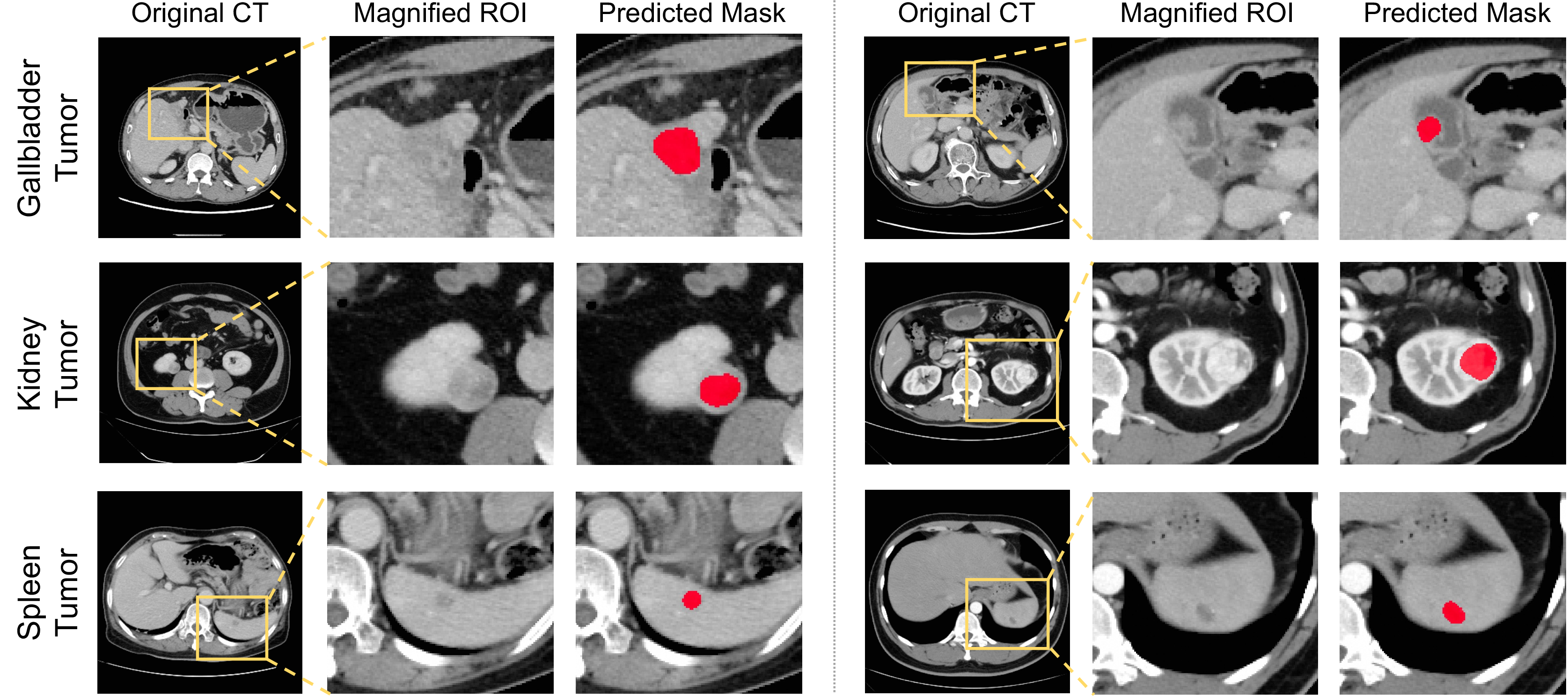 Figure 7: Visualization of unannotated lesion segmentation. For each representative case, the original CT slice, corresponding magnified ROI, and predicted lesion mask are presented.
