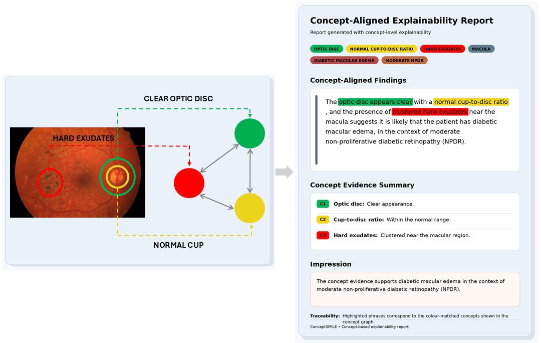 Figure 8: Qualitative ConceptSMILE output illustrating traceable alignment between retinal concept evidence, the concept graph, and the generated concept-level report. Colour-matched highlights link the clear optic disc, normal cup-to-disc ratio, and hard-exudate concepts to their corresponding textual evidence.