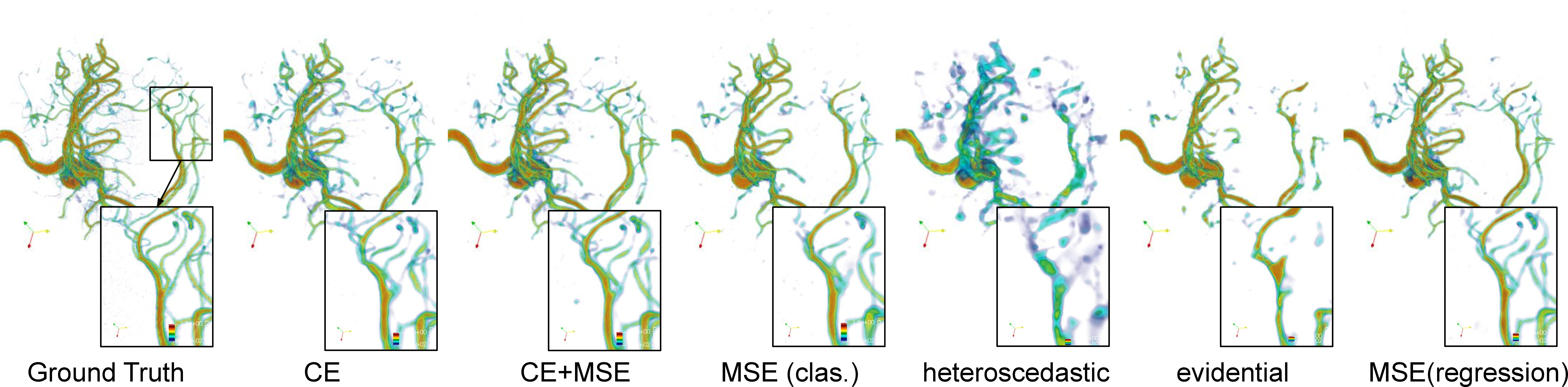 Figure 3: A qualitative comparison between classification-based and regression-based approaches over aneurism dataset. Both heteroscedastic and evidential regression struggle to fit thin vessels and small branches, which are fine-grained and high-frequency features.