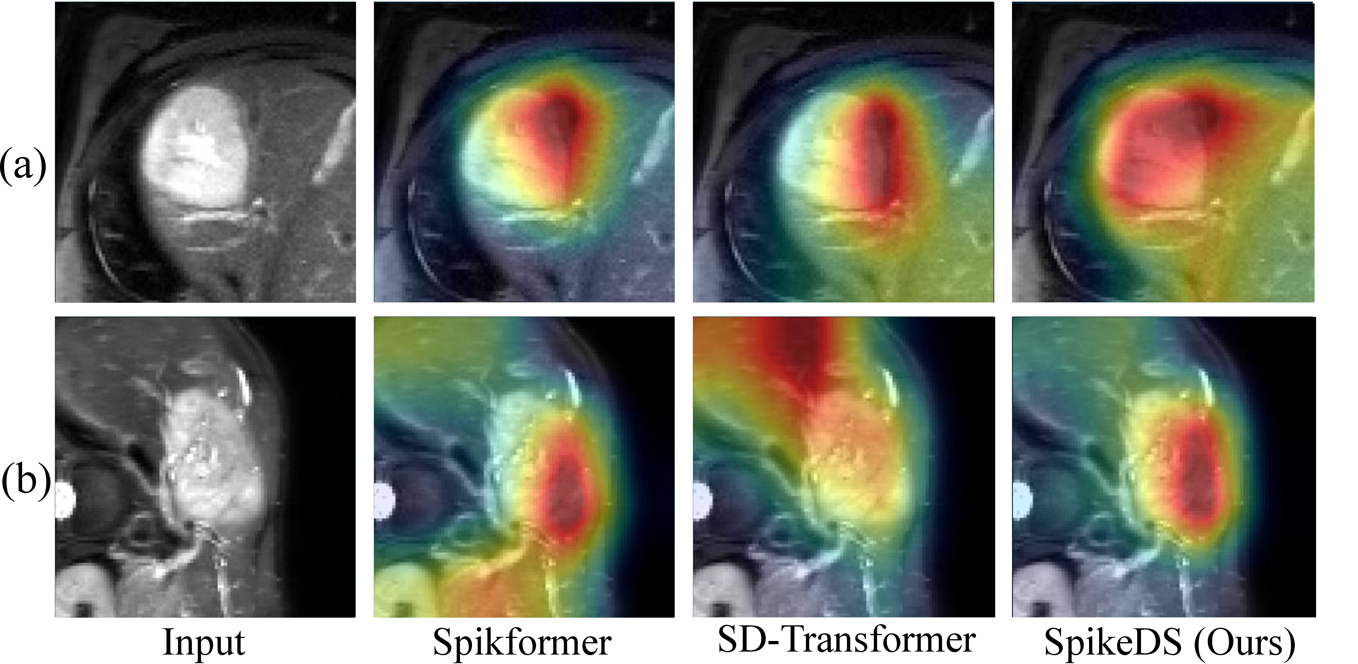 Figure 2: Attention maps based on Spike Firing Rate (SFR). These visualizations illustrate the spatial density of spike activations within the input volume for (a) PNI-positive and (b) PNI-negative cases.