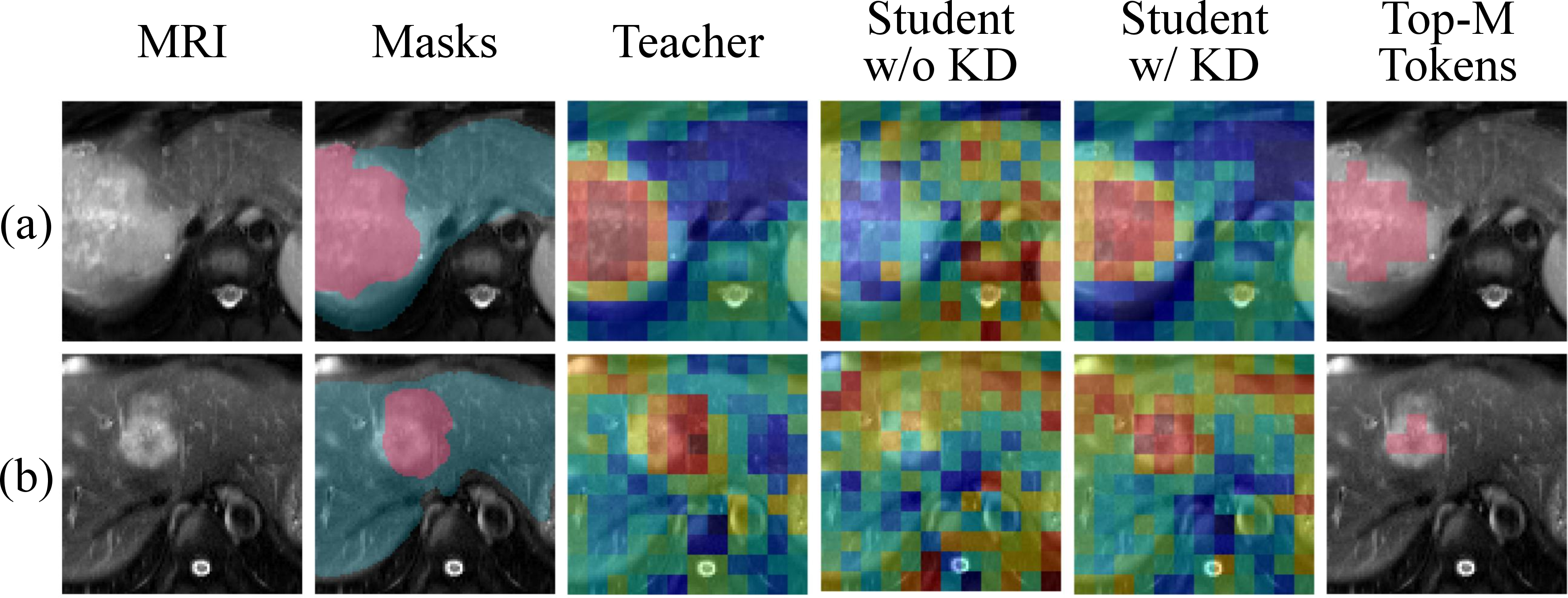 Figure 3: Qualitative routing comparison at M{=}64 for representative (a) PNI-positive and (b) PNI-negative patients. From left to right: MRI, masks, teacher routing, student routing without distillation, student routing with distillation, and top-M retained tokens. Distillation suppresses diffuse background responses and concentrates routing on lesion-related and adjacent regions.
