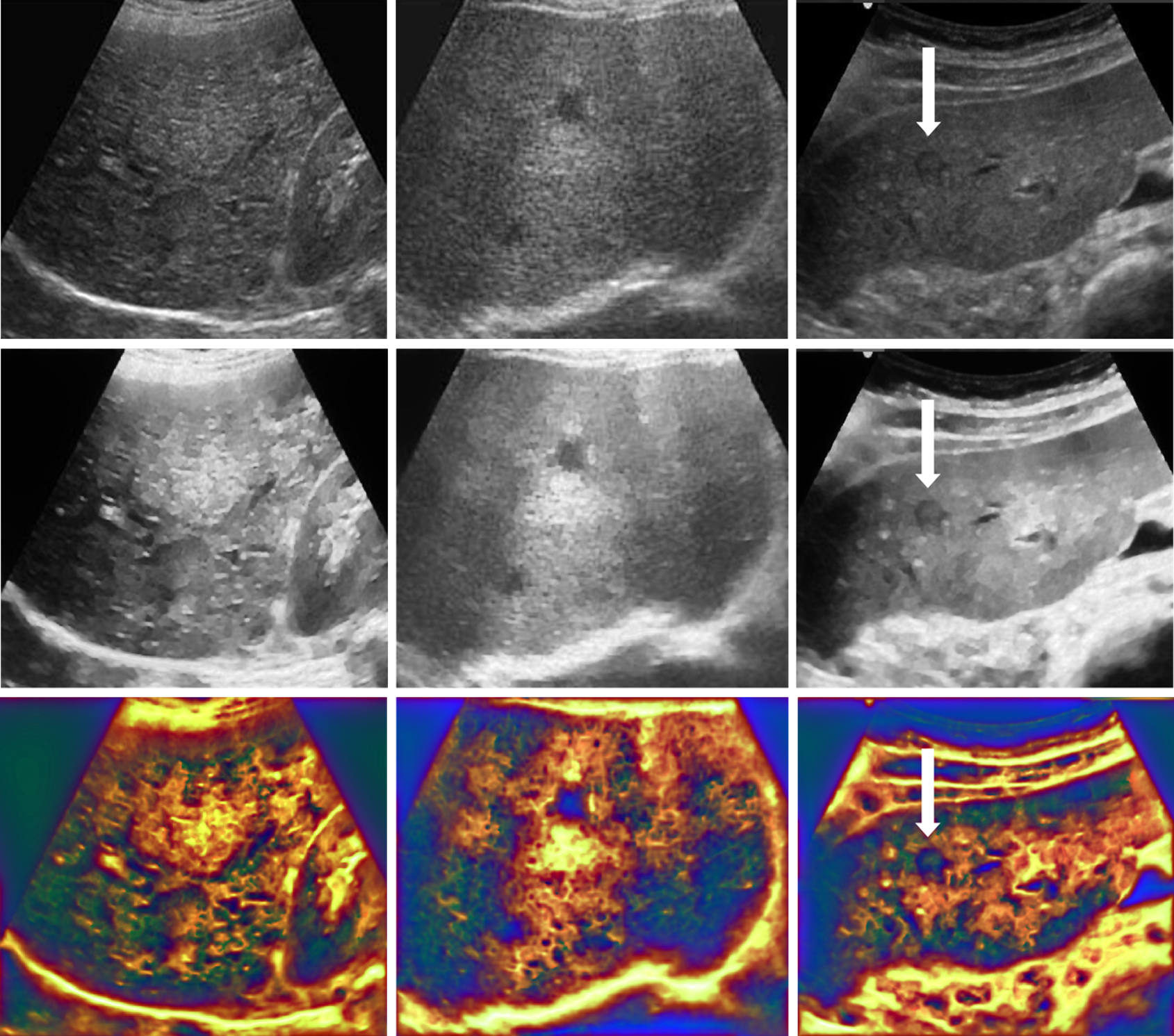 Figure 1: Original liver ultrasound data (BUS) top row, and the enhanced representations QiUS (middle row), and EnUS (last row).
