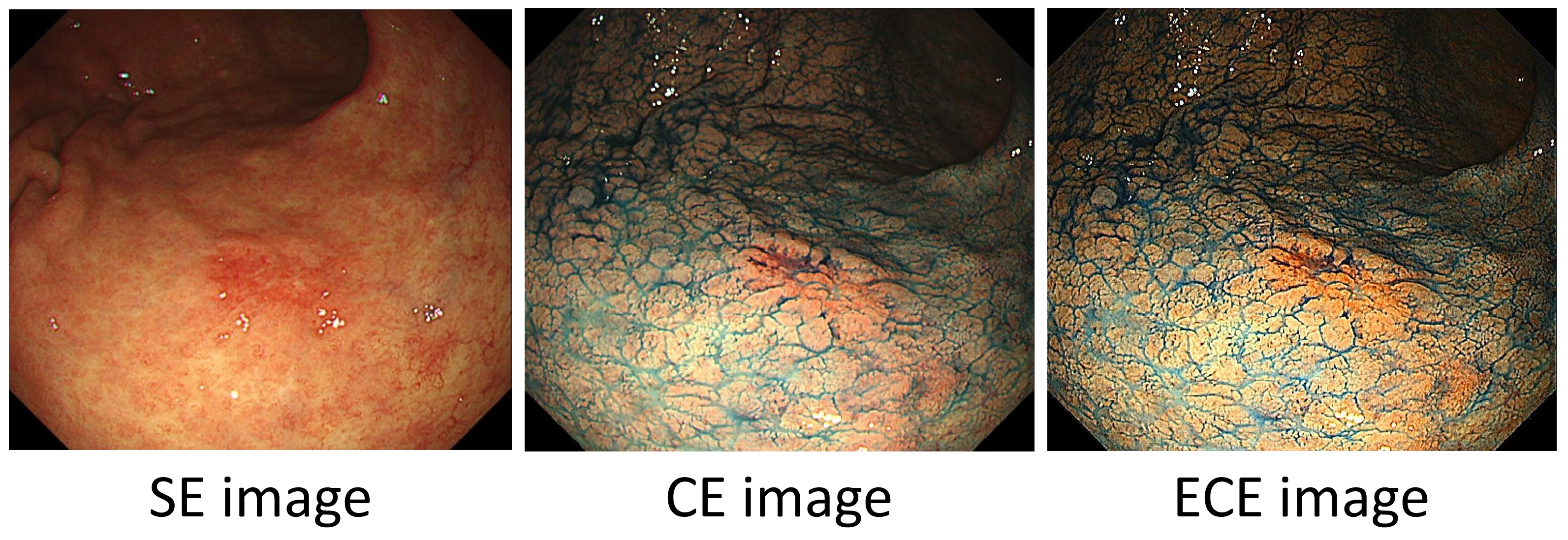 Figure 1: The comparisons of a standard endoscopy (SE) image, a chromoendoscopy (CE) image, and an enhanced chromoendoscopy (ECE) image.