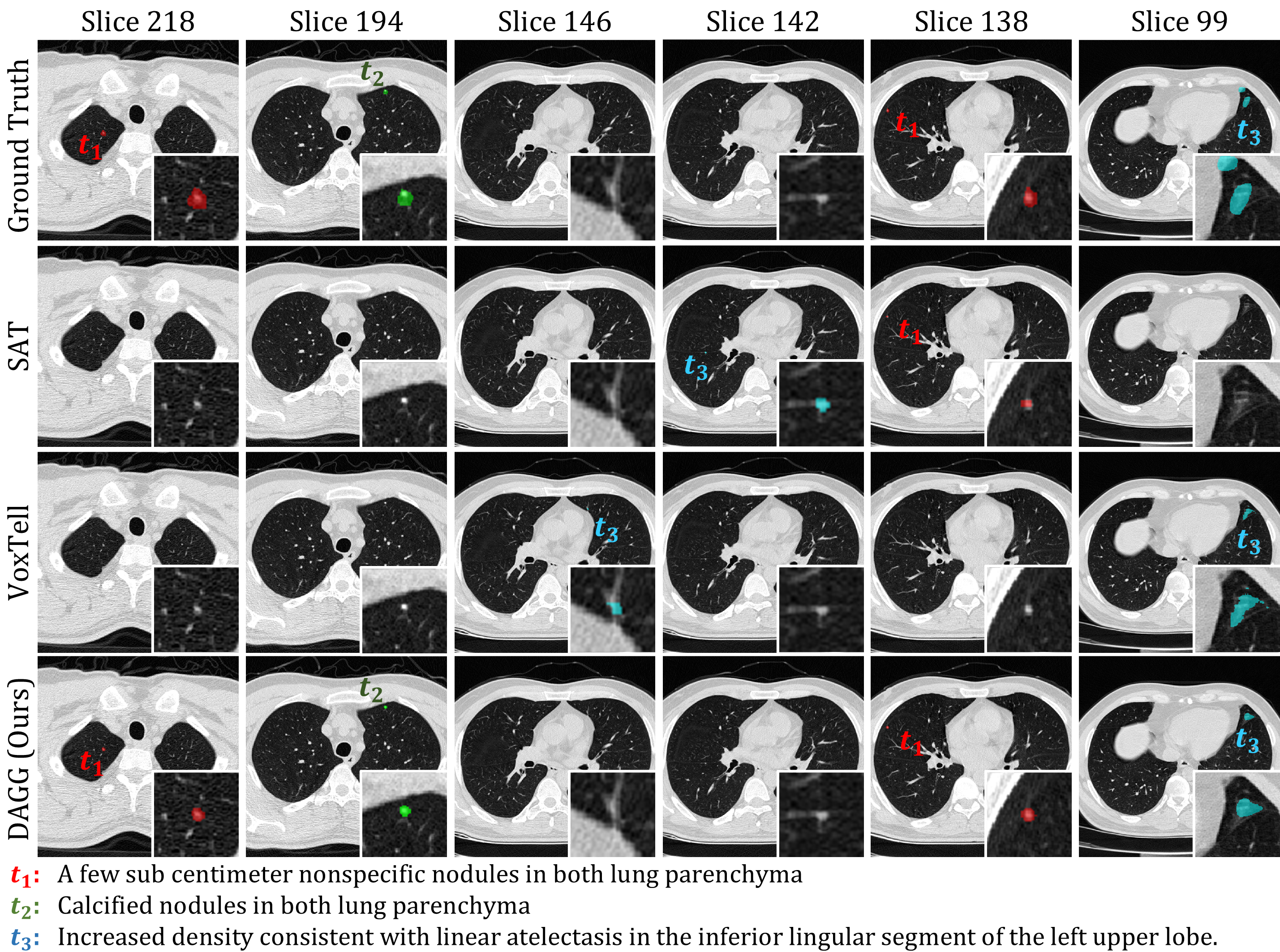 Figure 2: Qualitative results for the grounding of free-text findings across multiple slices.