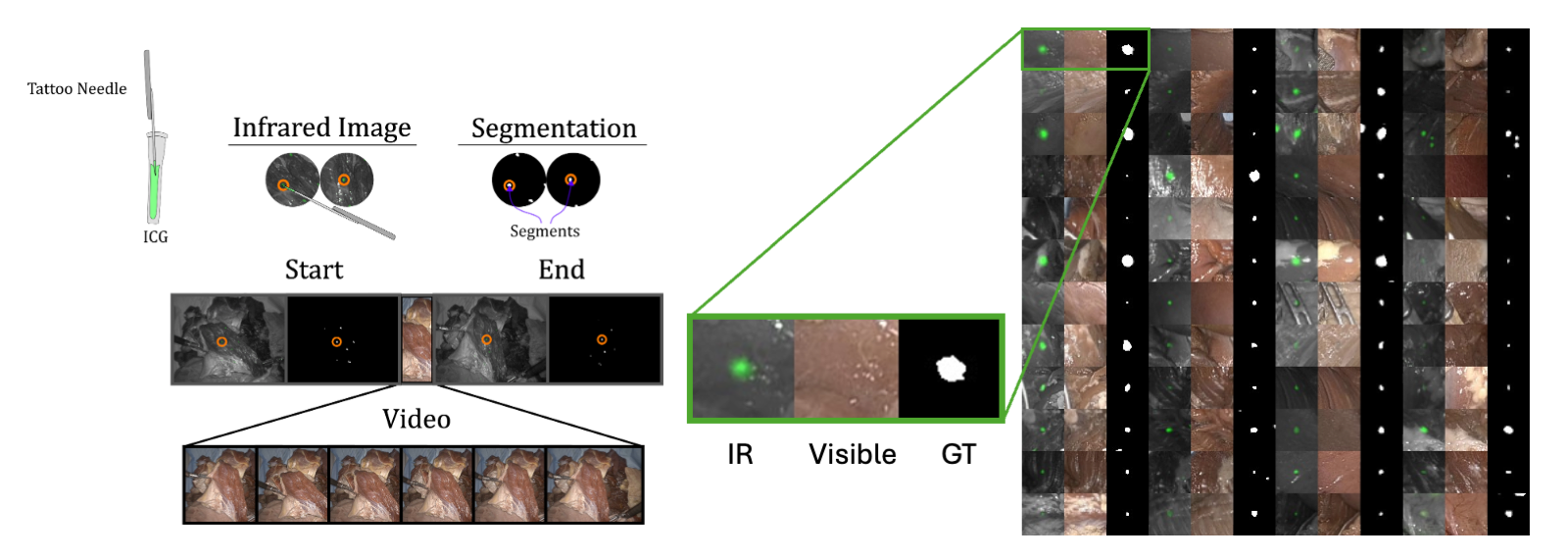 Figure 5: Dataset label creation process. Ground truth (GT) data is collected by using a tattoo needle to label points at the start and end of video frames. After tattooing is completed, multiple sequences can be collected. For each sequence, the camera captures an image in infrared (GT start frame), then switches to white light. Actions are performed under white light, and this video is recorded and saved. Then the camera switches back to IR and captures the end frame which is used as the GT for each point’s motion. Segments are the binary-thresholded IR images; tattooed regions are shown in white. On the right is a figure showing a set of random triplets with the triplet: (IR image, visible light image, segment/GT image) for each point shown. Figure from [10]