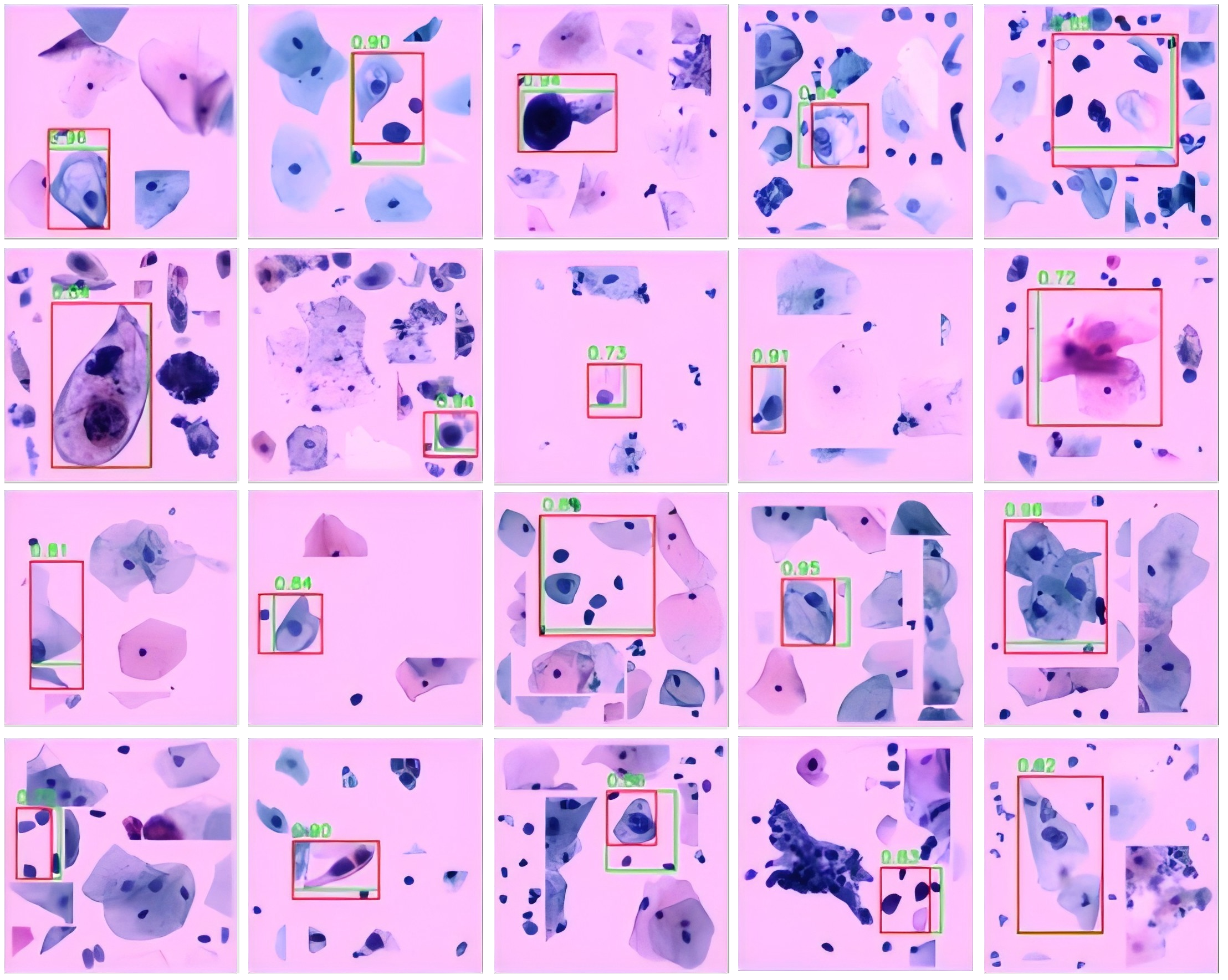 Figure 4: Illustrations of TCT image detection and recognition based on the proposed YoLo-D model and cell-norm method.