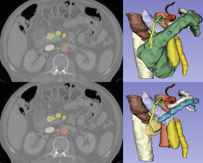 Figure 3: Qualitative examples of model predicted multiorgan and vascular segmentations. Left: axial CT slices with overlayed predicted labels. Right: corresponding 3D renderings illustrating pancreas, tumor, and major vessels.