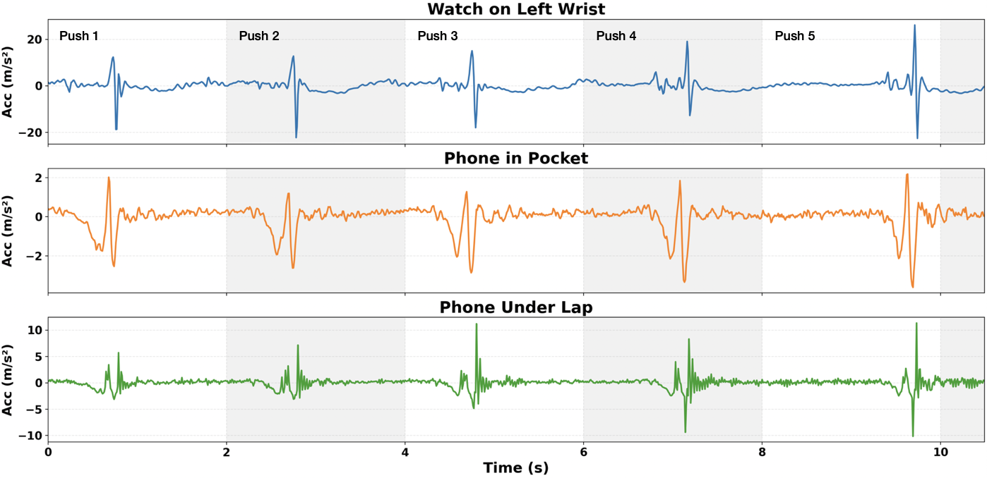 Figure 6: Synchronized accelerometer signals from a watch (wrist) and phones (pocket, under the lap) during five manual pushes. The clear temporal alignment of peaks across devices demonstrates that body-coupled phones capture propulsion dynamics comparable to wrist-worn wearables.
