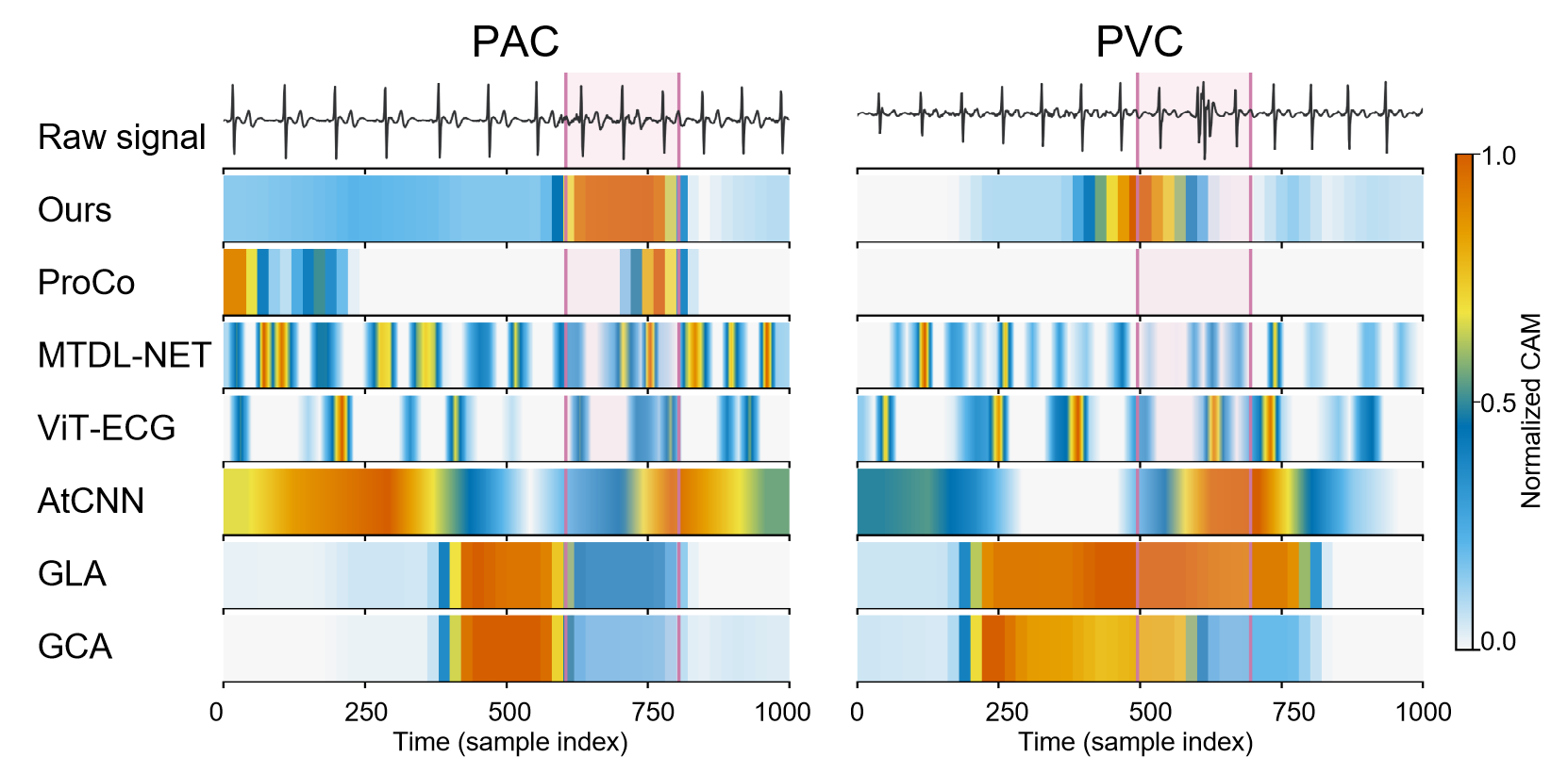 Figure 10: Qualitative Grad-CAM illustration on Noc-ECG. Beat-wise annotations are available only for Noc-ECG. Highlighted regions indicate annotated abnormal beats, and heatmaps compare where different methods.