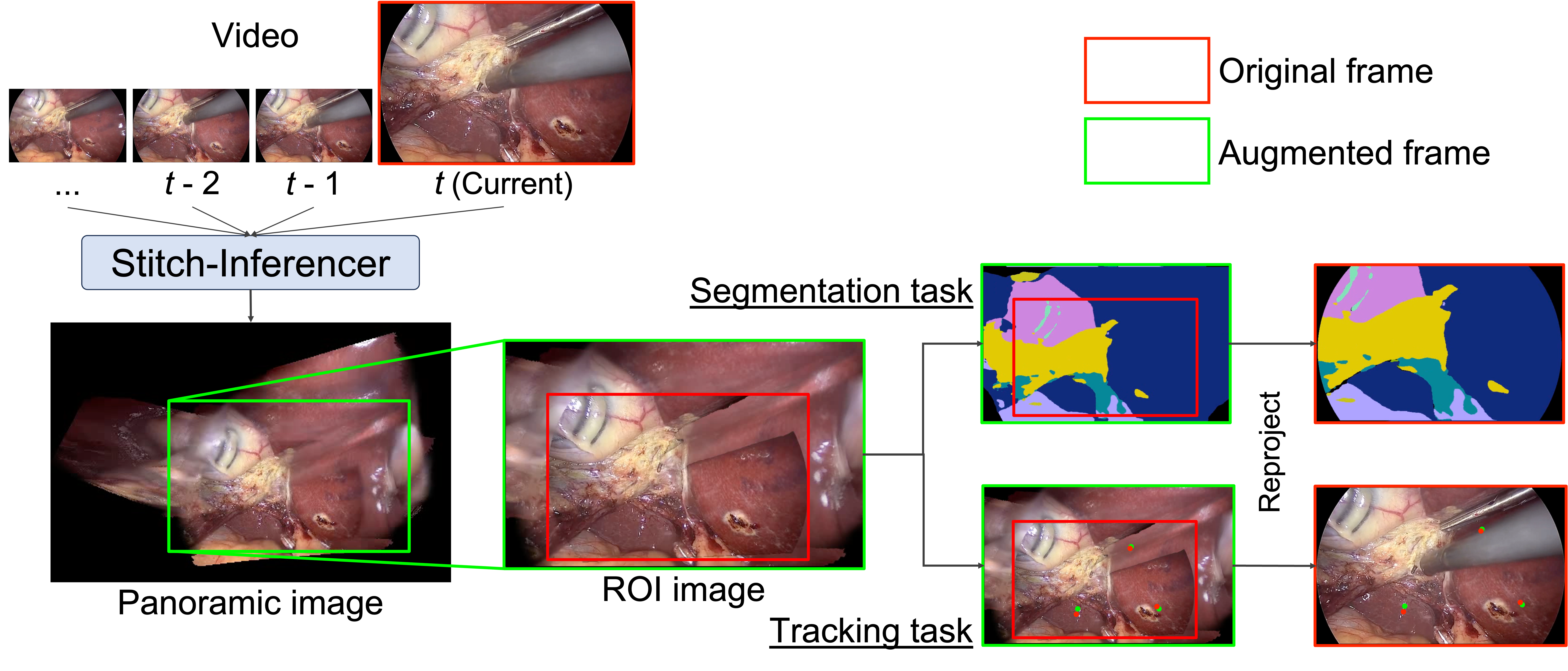 Figure 1: Graphical abstract. Stitch-Inferencer creates an instrument-free panoramic view and improves downstream segmentation and tracking at inference time without additional training; green and red boxes indicate the panorama context and the current-frame region with reprojection, respectively.