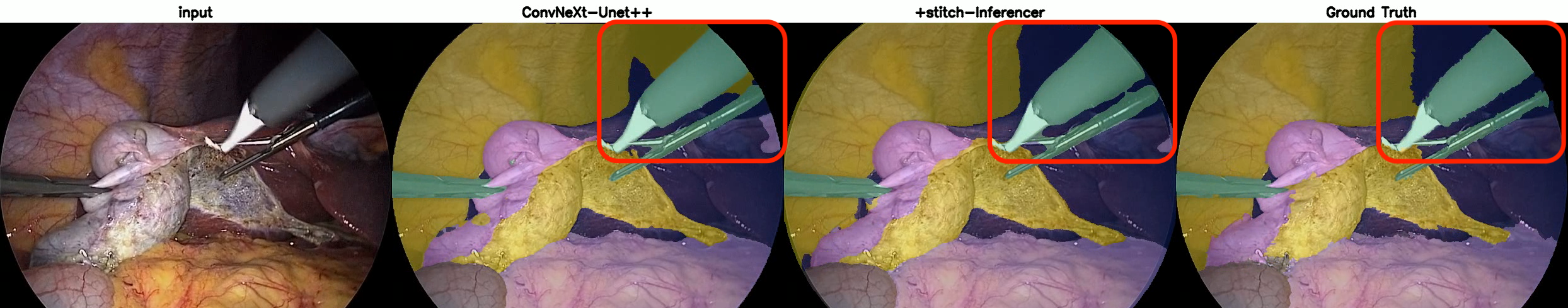 Figure 3: Qualitative anatomy segmentation example on CholecSeg8k with ConvNeXt-B UNet++. From left to right: input frame, original inference, Stitch-Inferencer inference, and ground truth. Red boxes highlight a peripheral region where Stitch-Inferencer better recovers the ground-truth segmentation by leveraging panoramic spatial context.