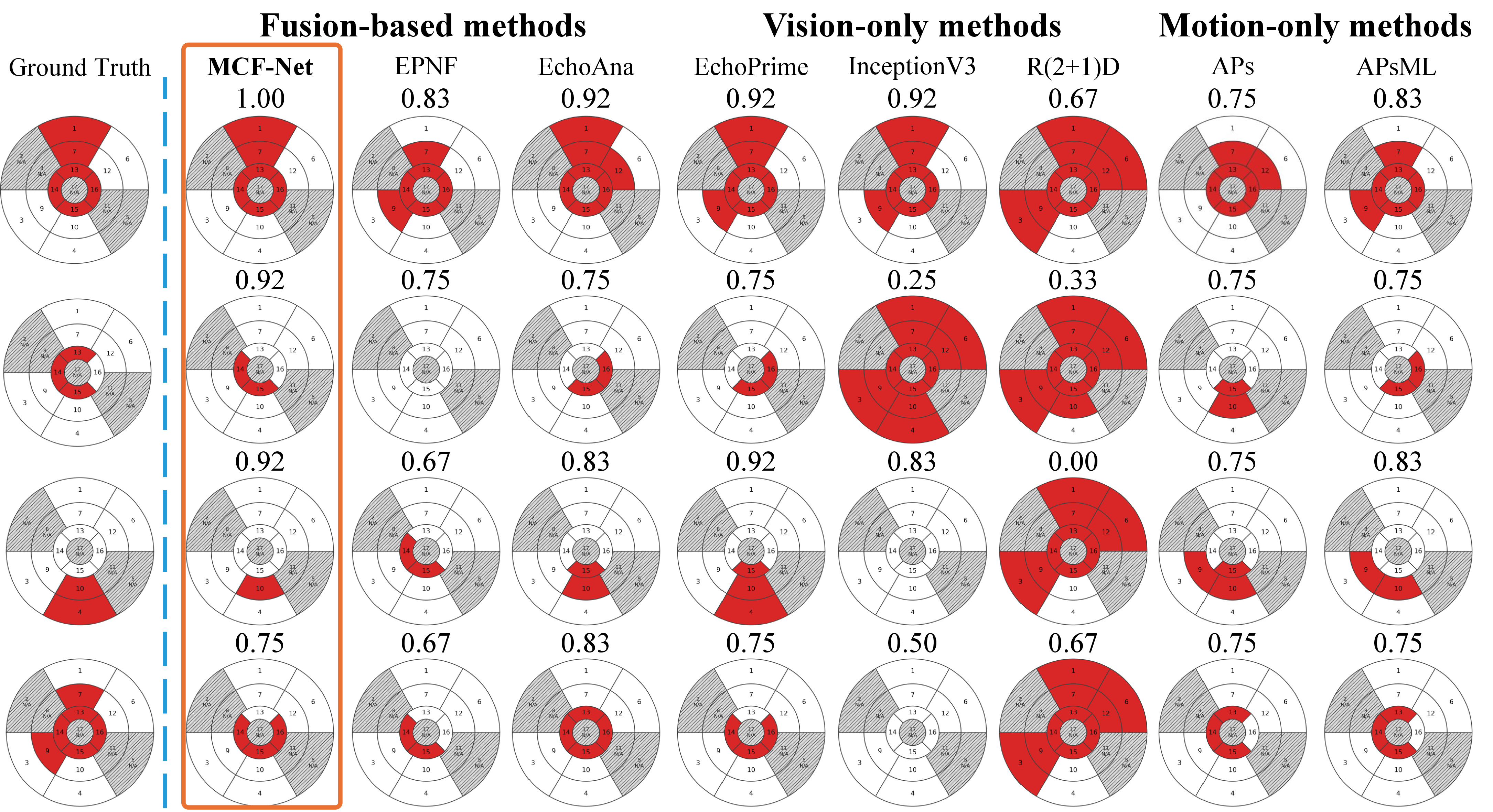 Figure 2: Qualitative comparison on AHA bullseye plots. Each “segment” denotes a standardized anatomical region of the left ventricle (apical/mid/basal; anterior/inferior, etc.), i.e., region-level labeling rather than pixel-wise segmentation. Red, white, gray denote infarct, healthy, and N/A regions, respectively. Rows show representative test cases selected by accuracy quartiles (0.75: lower, 0.92: median, 1.00: upper), comparing Ground Truth (GT) with MCF-Net (Ours) and baselines grouped by modality (Fusion, Vision, Motion). Numbers indicate accuracy.
