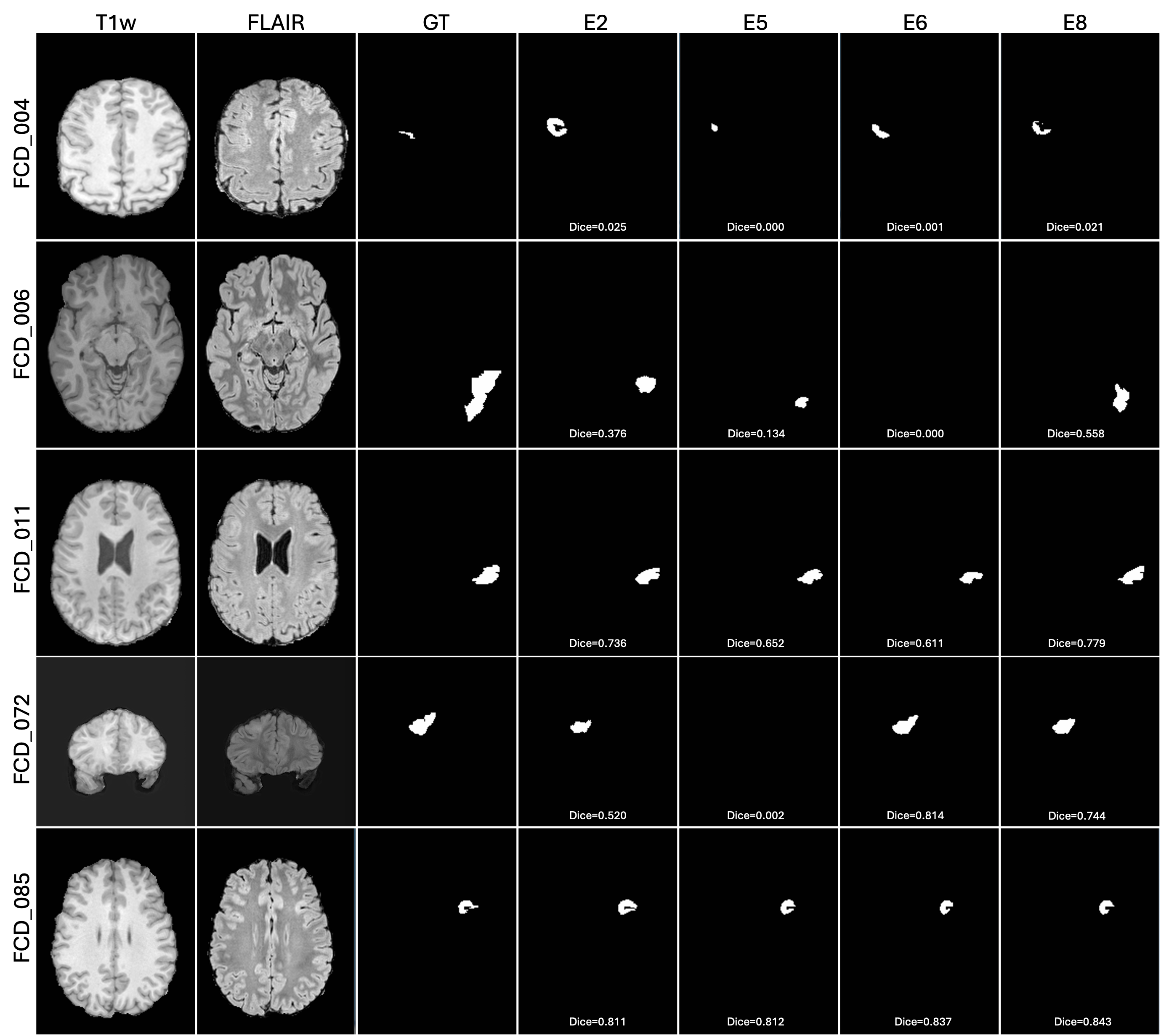 Figure 3: Representative qualitative segmentation results for five FCD subjects. For each subject (rows), the columns show the T1w image, FLAIR image, expert-annotated ground-truth (GT) lesion mask, and the predicted segmentations from E2 (FLAIR), E5 (T1w+FLAIR), E6 (E5+T1w/FLAIR), and E8 (E5+T1w/FLAIR+FLAIR/T1w). Dice scores are reported below each prediction.