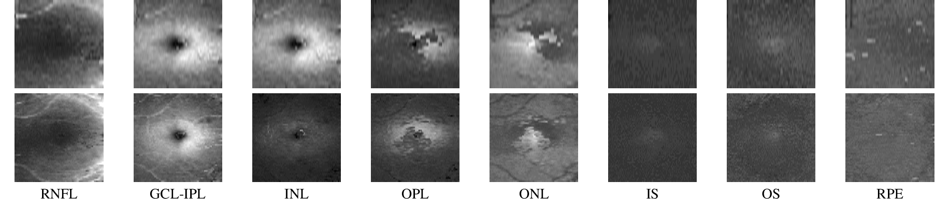 Figure 6: MServet FastMac and PPole datasets. Thickness maps of retinal layers obtained from the same patient with multiple sclerosis, acquired using the FastMac (top) and PPole (bottom) protocols. Details best viewed with zooming.