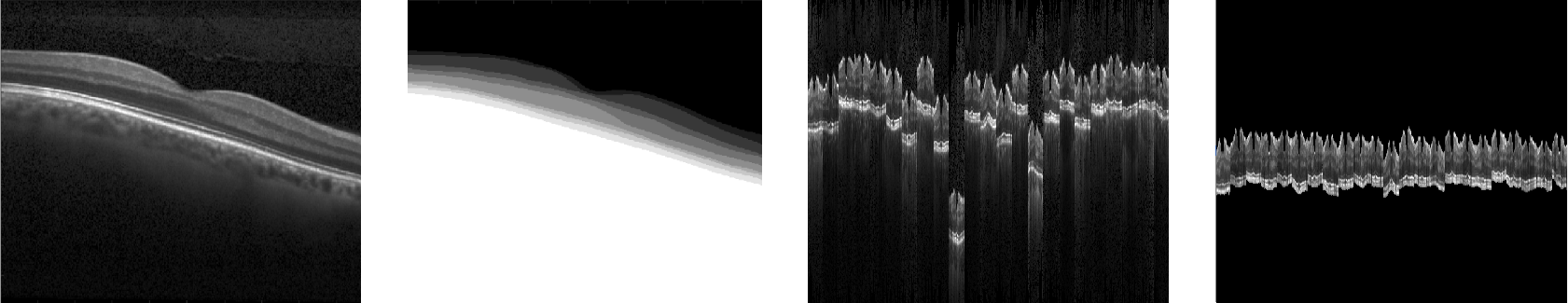 Figure 3: JHopkins dataset. From left to right, fovea-crossing B-scan and corresponding segmentation of the retinal layers (grey scale), vitreous (black), and choroid (white) in one subject; B-scans from the training set in the plane orthogonal to the B-scans; and B-scans from the training set after spatial normalization, also in the orthogonal plane to the B-scans.